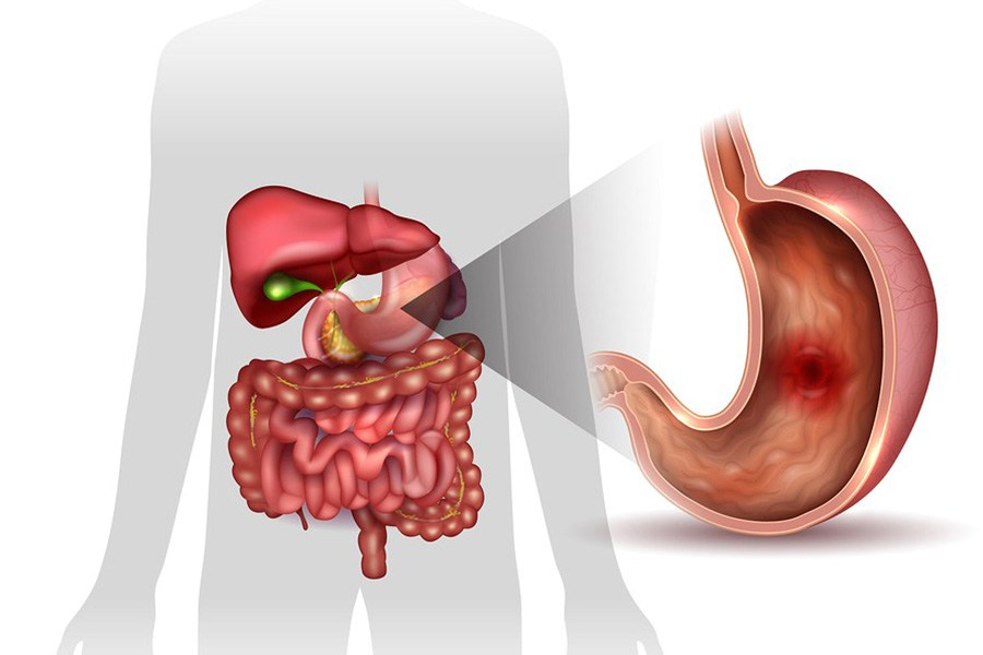 Gastric Ulcer