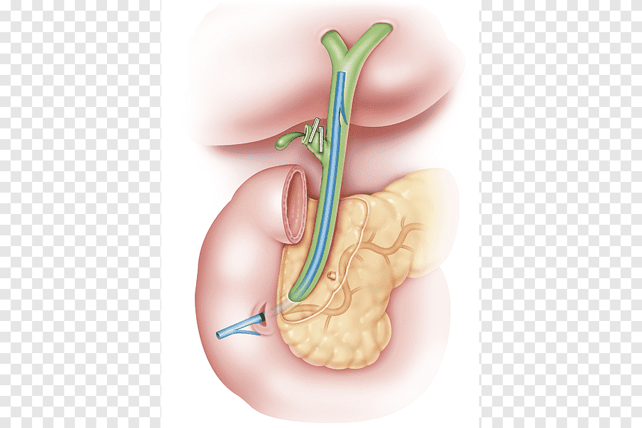 Common Bile Duct Exploration