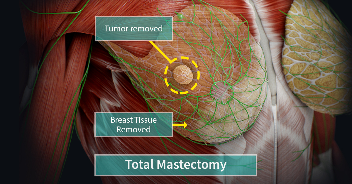 Mastectomy