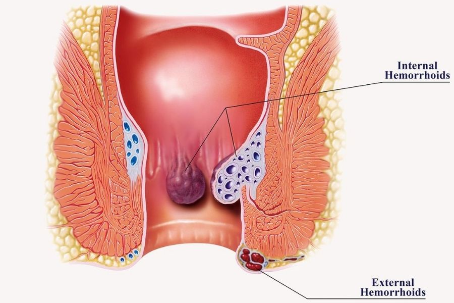 Anal and rectal surgeries