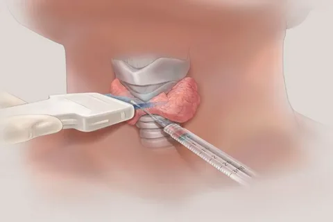 استئصال الغدة الدرقية
