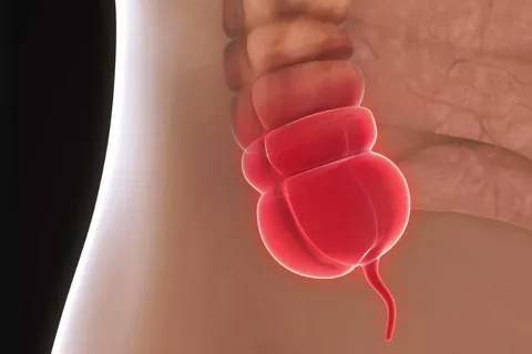  الاستئصال الزائدة 