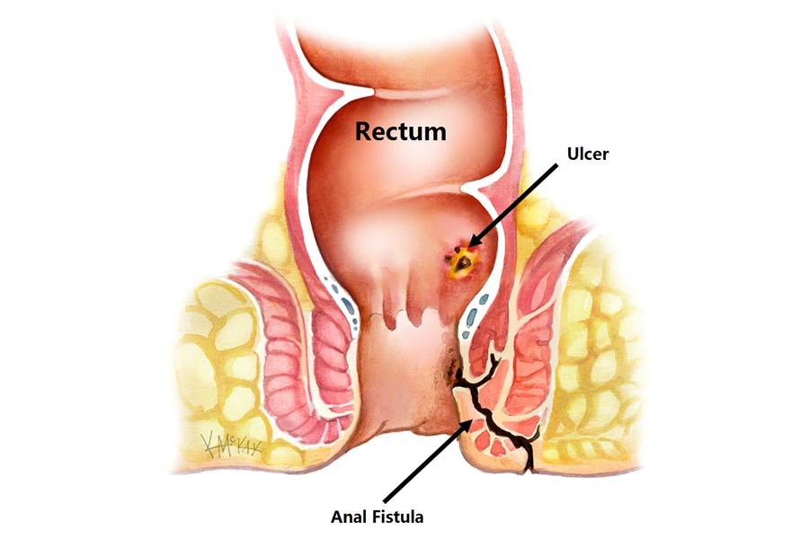 Anal Fistula
