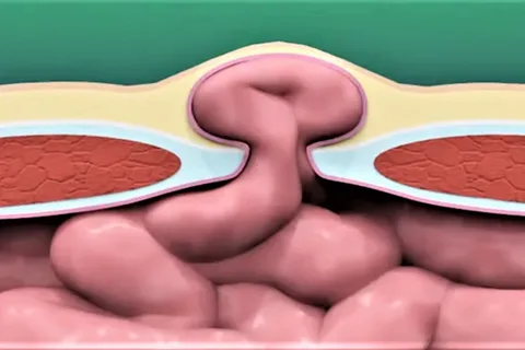Anal Fissure